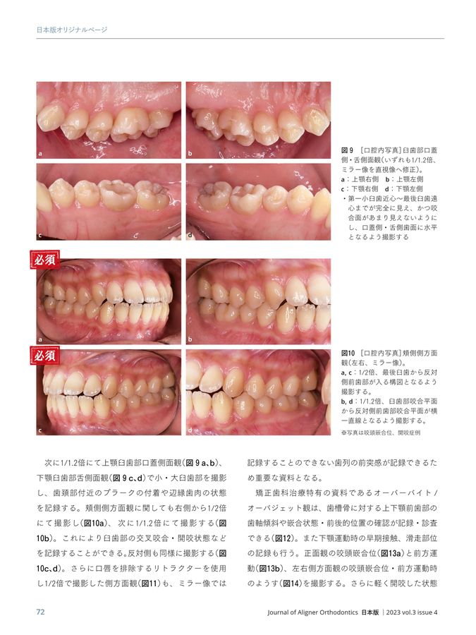 Journal of Aligner Orthodontics 日本版 2023年No4