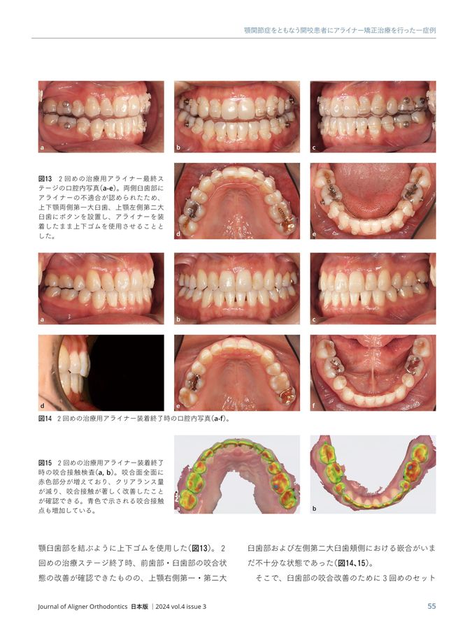 Journal of Aligner Orthodontics 日本版 2024年No3