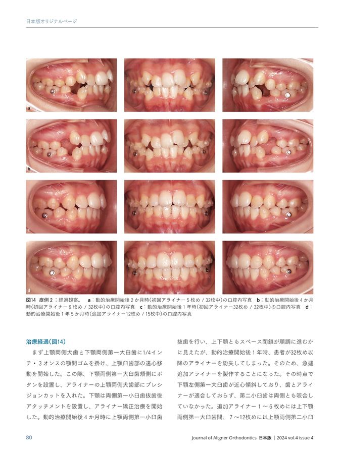 JAO［Journal of Aligner Orthodontics］日本版 2024年No.4