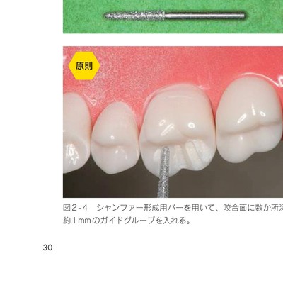 支台歯形成のかんどころ
