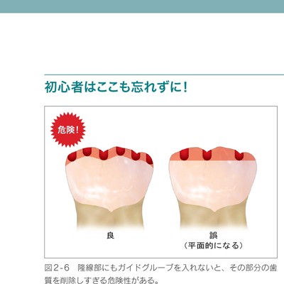 支台歯形成のかんどころ