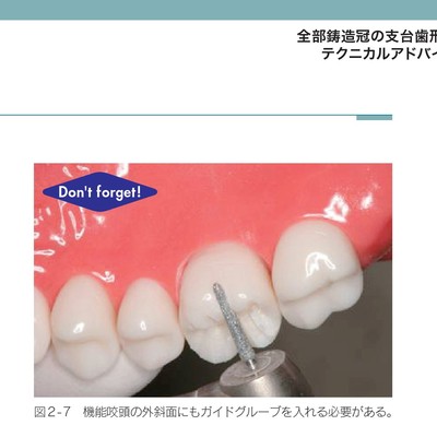 支台歯形成のかんどころ