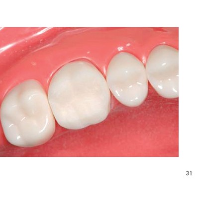 支台歯形成のかんどころ