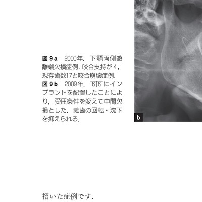 欠損歯列」の読み方,「欠損補綴」の設計