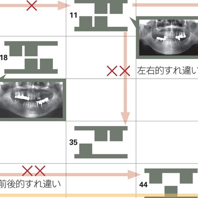 欠損歯列」の読み方,「欠損補綴」の設計