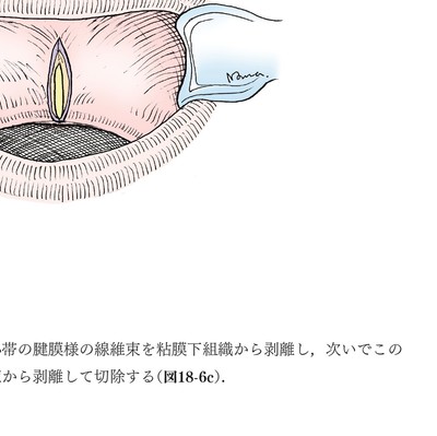 イラストでみる　口腔外科手術 第3巻 イラストでみる口腔外科手術 第3巻 - クインテッセンス出版