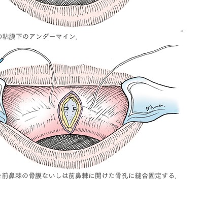 イラストでみる口腔外科手術 第3巻