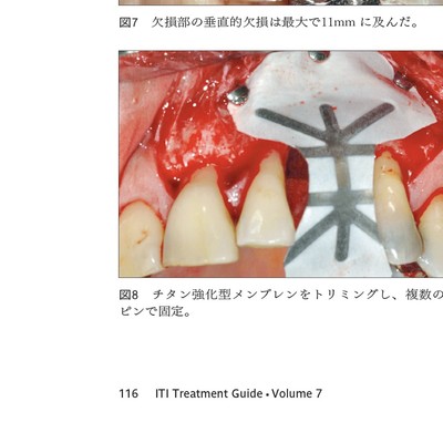 ♠裁断済 ITI Treatment Guide : Volume 7 ITI treatment guide : Japanese volume 7 - メルカリ