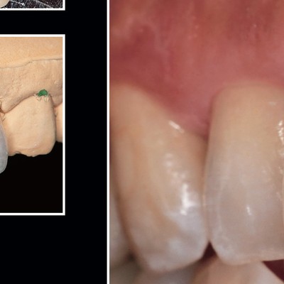 青嶋仁 歯科技工臨床写真集 ザ・セラミックワークス