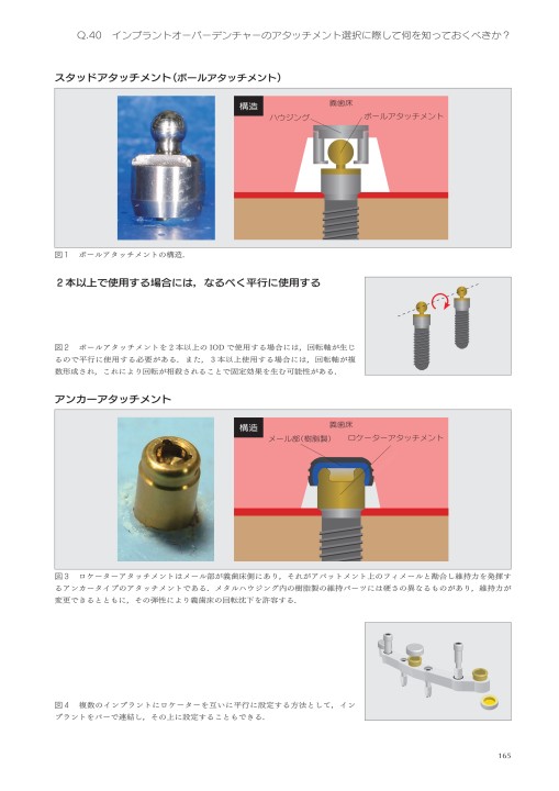 インプラントオーバーデンチャーの臨床とエビデンスQ＆A