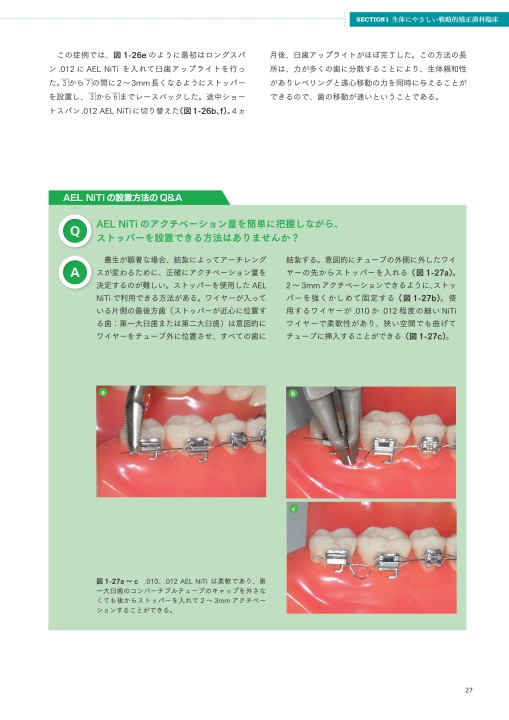 生体にやさしい戦略的矯正歯科治療と歯科矯正用アンカースクリューの応用 生体にやさしい戦略的矯正歯科治療歯科矯正用アンカースクリューの応用