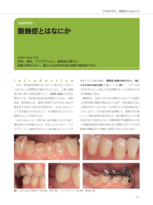 知る・診る・対応する 酸蝕症