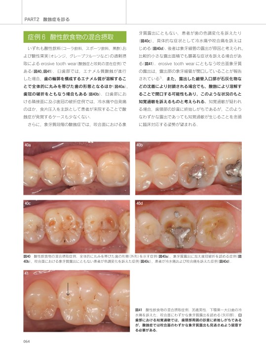 知る・診る・対応する 酸蝕症