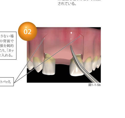 3Dイラストで見るペリオドンタルプラスティックサージェリー