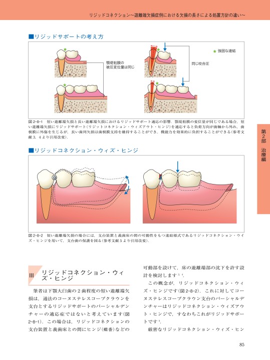 パーシャルデンチャー治療 失敗回避のためのポイント47