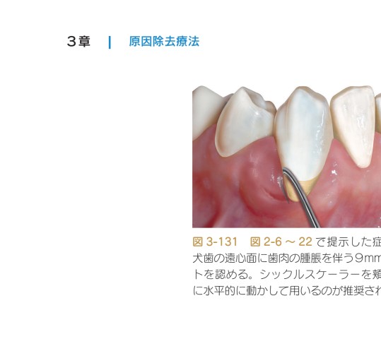 【裁断済み】歯科衛生士の力でここまでできる非外科的歯周治療 裁断済み】歯科衛生士の力でここまでできる非外科的歯周治療