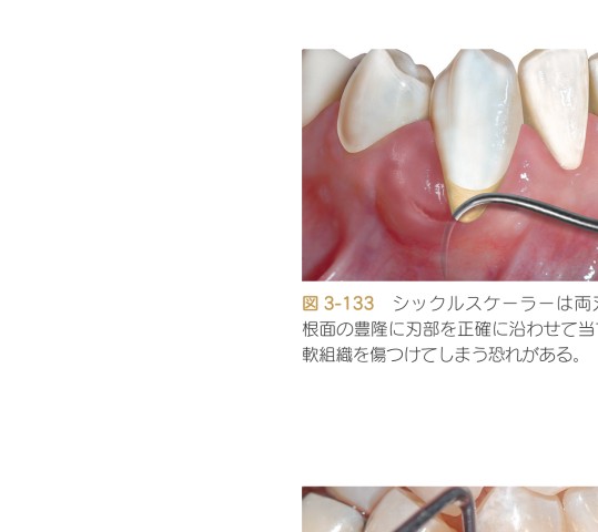 歯科衛生士の力でここまでできる 非外科的歯周治療