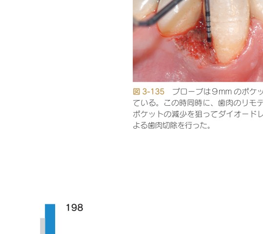 【裁断済み】歯科衛生士の力でここまでできる非外科的歯周治療 裁断済み】歯科衛生士の力でここまでできる非外科的歯周治療