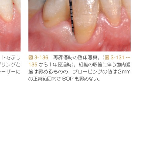 歯科衛生士の力でここまでできる 非外科的歯周治療 歯科衛生士の力でここまでできる 非外科的歯周治療 | Marisa