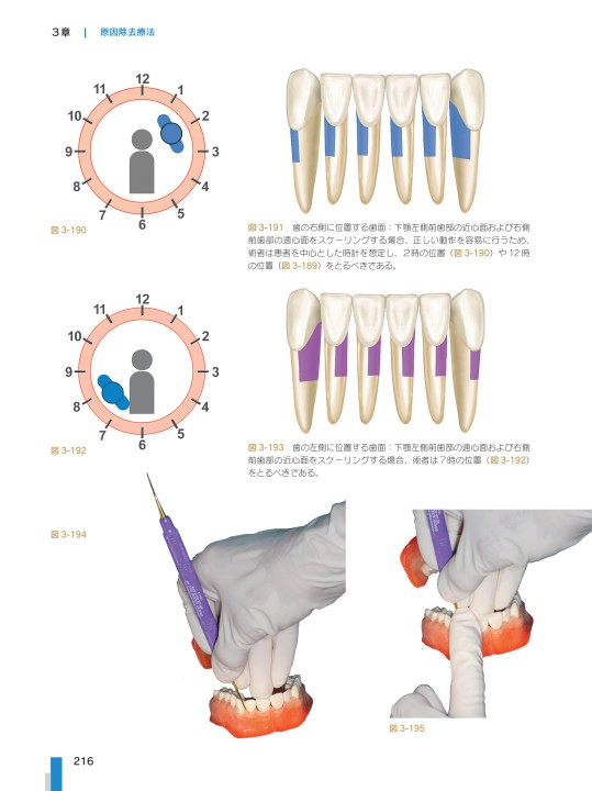 歯科衛生士の力でここまでできる 非外科的歯周治療