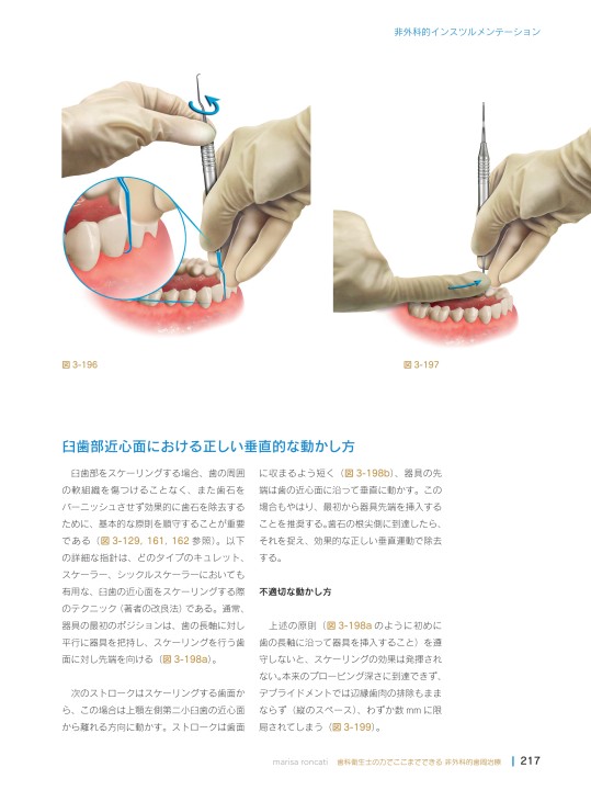 歯科衛生士の力でここまでできる 非外科的歯周治療