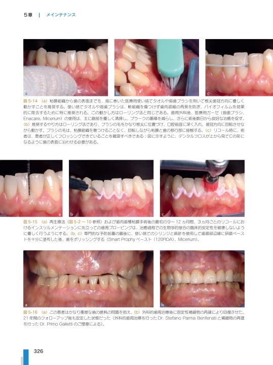 歯科衛生士の力でここまでできる 非外科的歯周治療