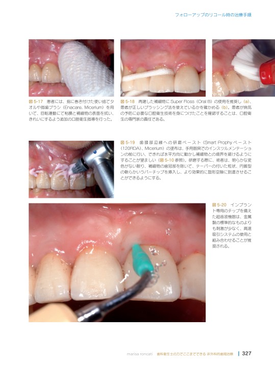 歯科衛生士の力でここまでできる 非外科的歯周治療