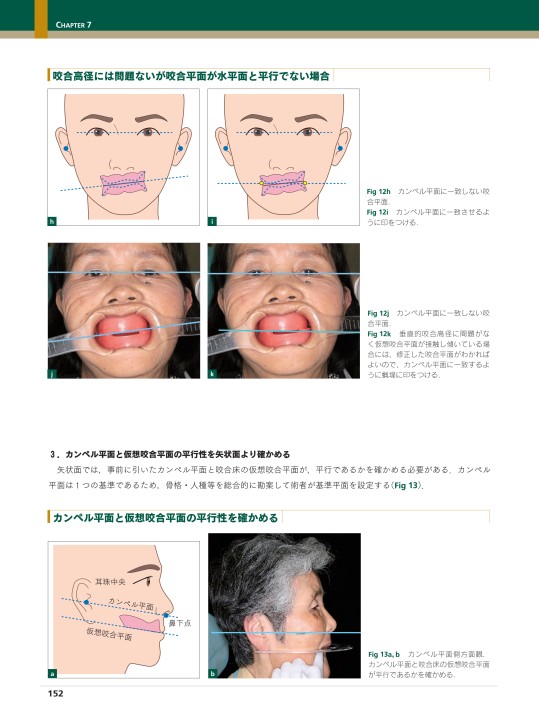 生体に優しい総義歯製作法