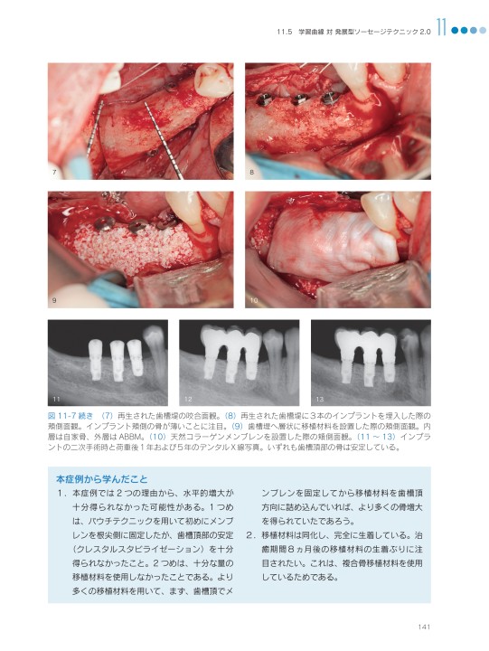 垂直的および水平的歯槽堤増大術