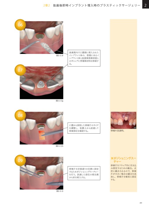 3Dイラストで見るペリオドンタルプラスティックサージェリー