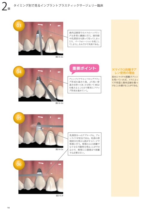 3Dイラストで見るペリオドンタルプラスティックサージェリー