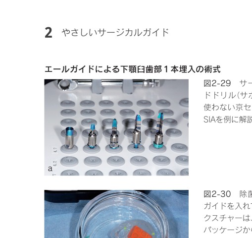 やさしいインプラント治療 初めての1本埋入をガイドします! やさしいインプラント治療 初めての1本埋入をガイドします！