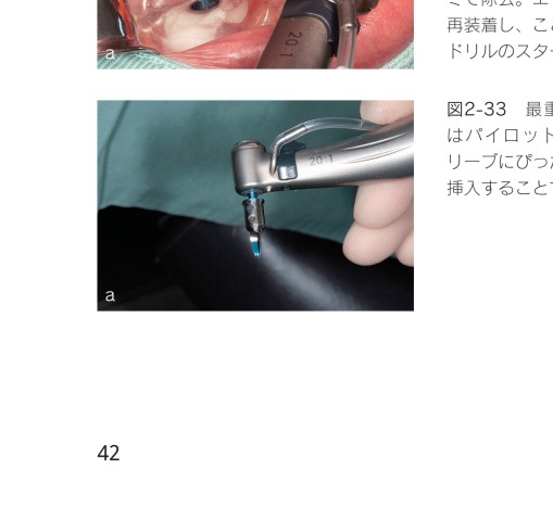 やさしいインプラント治療 初めての1本埋入をガイドします！