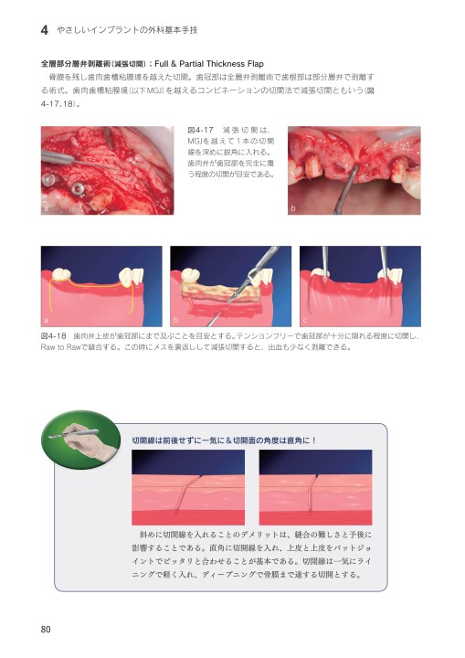 やさしいインプラント治療 初めての1本埋入をガイドします！
