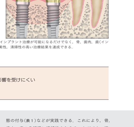 図解！遅延型吸収性膜を用いた 安全安心GBR