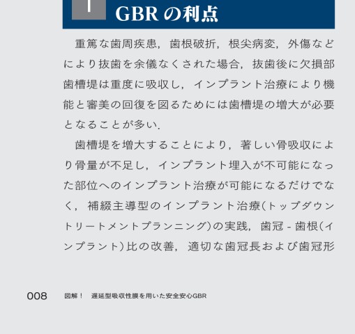 図解！遅延型吸収性膜を用いた 安全安心GBR