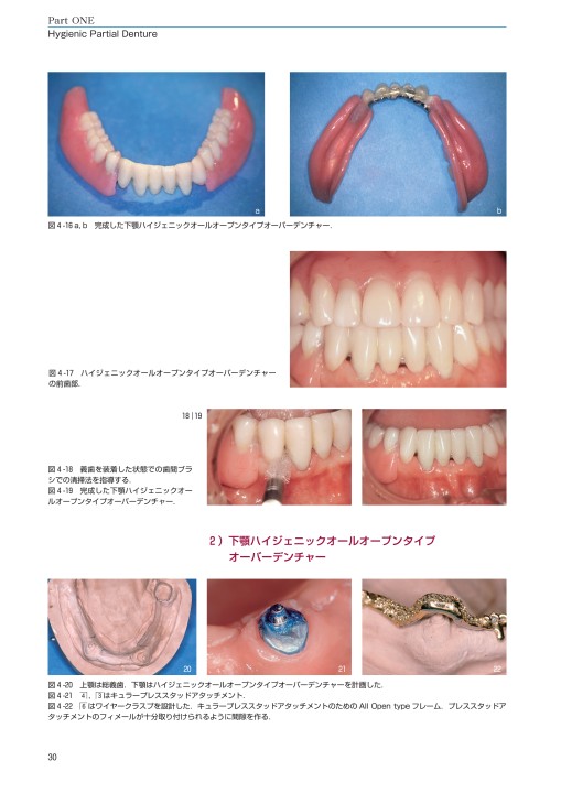 Hygienic Partial DentureとMyo-Dentureの最新臨床アトラス