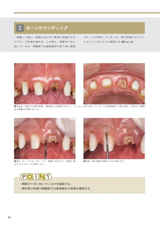 成功の方程式 図解！ 歯周外科を用いた歯肉縁下う蝕の治療手順