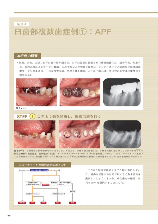 成功の方程式 図解！ 歯周外科を用いた歯肉縁下う蝕の治療手順