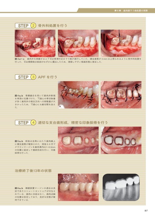 成功の方程式 図解！ 歯周外科を用いた歯肉縁下う蝕の治療手順