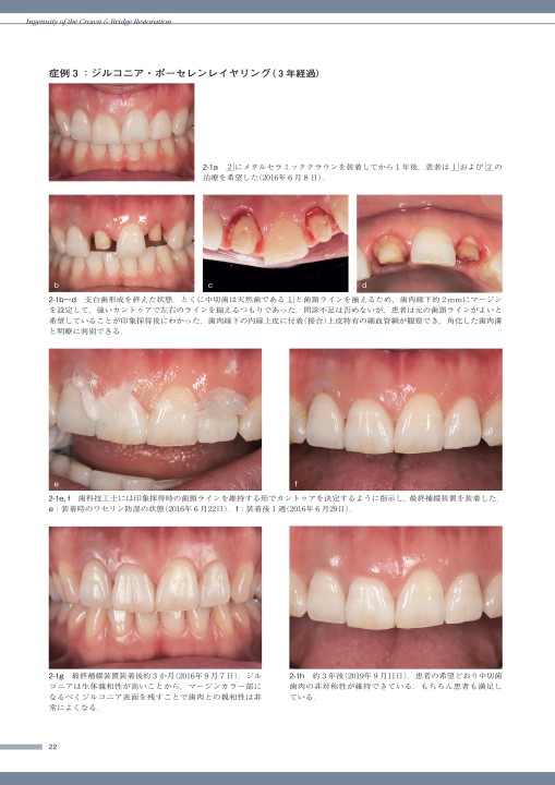 攻めのクラウン・ブリッジ