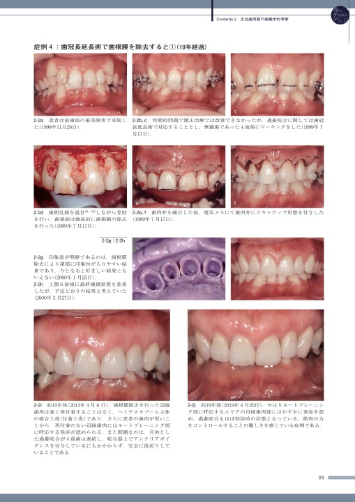 攻めのクラウン・ブリッジ