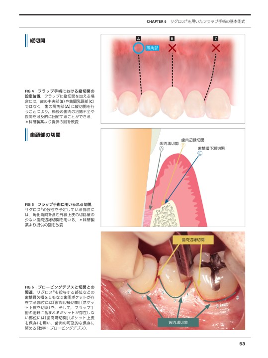 FGF-2と歯周組織再生療法