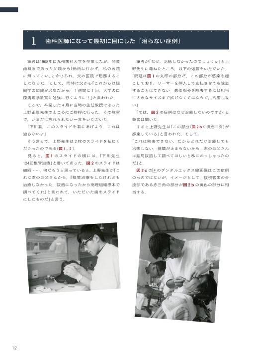 長期経過症例から紐解く根尖病変と骨縁下欠損