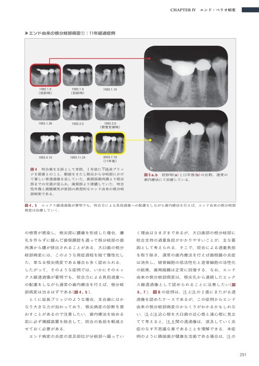 長期経過症例から紐解く根尖病変と骨縁下欠損