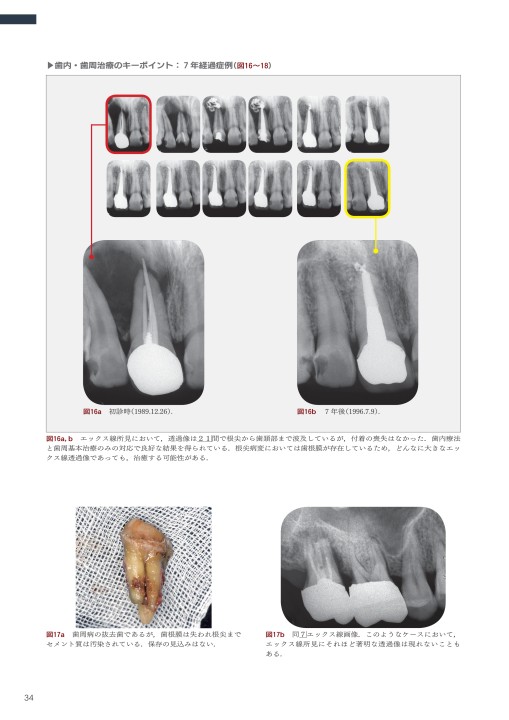 長期経過症例から紐解く根尖病変と骨縁下欠損