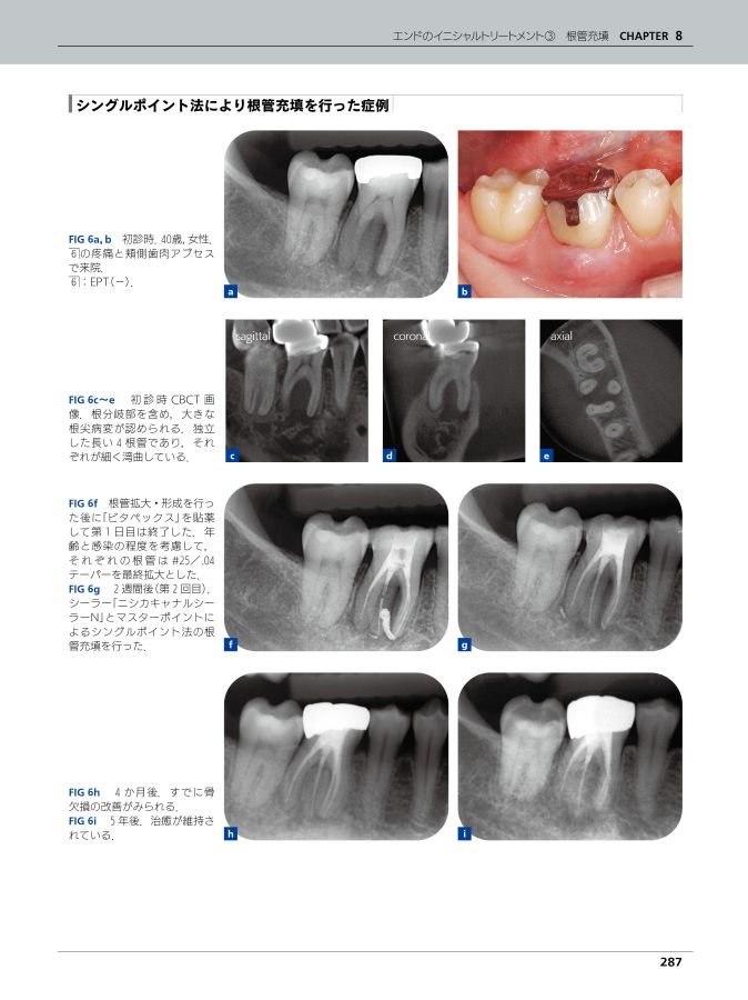 治癒の歯内療法 第3版