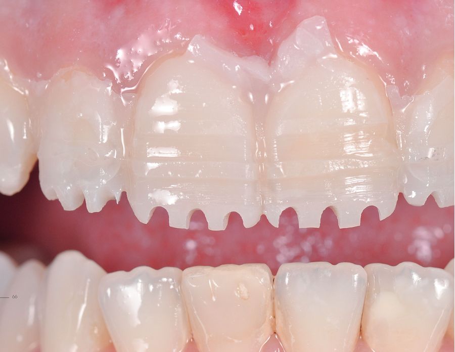 ラミネートベニア スマイルデザインのレシピ20