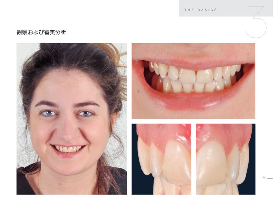 ラミネートベニア スマイルデザインのレシピ20