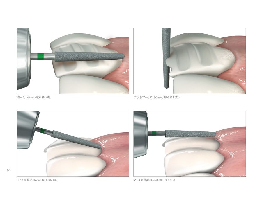 ラミネートベニア スマイルデザインのレシピ20